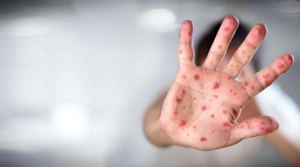 Fahrettin Koca Announces 5 New Monkeypox Cases Detected