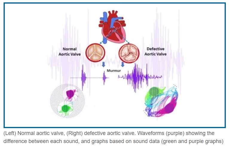 Artificial Intelligence analyzes up to 100% heart failure from heart sounds